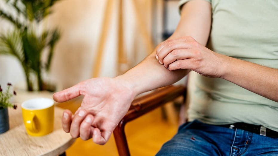 Scratching a mosquito bite worsens inflammation but may offer bacterial defense, study finds